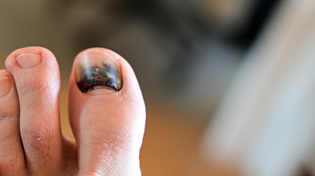 stubbed finger toe after with black nail 