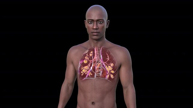 A man with lungs affected by cystic fibrosis, a genetic disorder causing thick mucus production. 3D animation shows bronchi dilation due to mucus accumulation and inflammation.