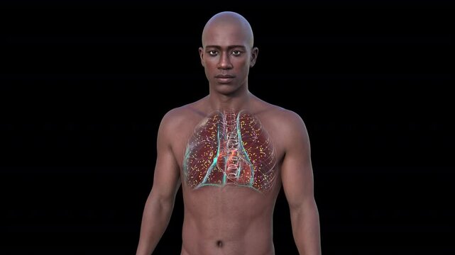 A man with lungs affected by miliary tuberculosis, a disseminated form of tuberculosis characterized by numerous tiny lesions scattered throughout the lungs, 3D animation.