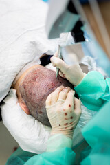 Vertical photograph of the detail of a surgeon performing a hair extraction in a hair graft operation.Concept of getting hair or hair operation. ©  Yistocking