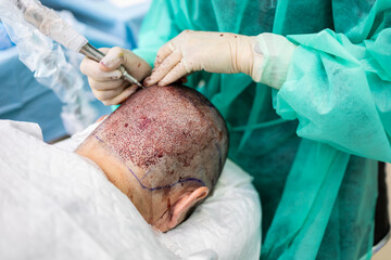 Photograph of the detail of a surgeon performing a hair extraction in a hair graft operation.Concept of getting hair or hair operation. ©  Yistocking