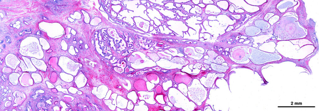 Human prostatic hyperplasia
