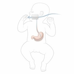 illustration of neonate being fed through nose via a nasogastric or NG tube
