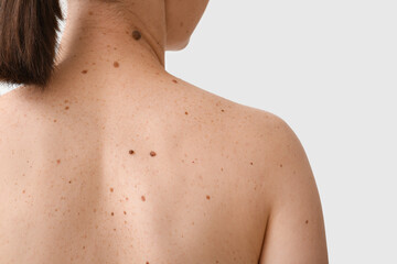 Naklejka premium Woman with moles on her back against white background, closeup
