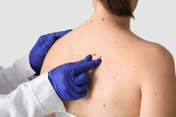 Dermatologist examining moles on woman's back in clinic, closeup