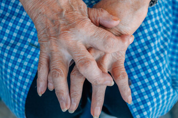 hands of a 90s woman with osteoarthritis