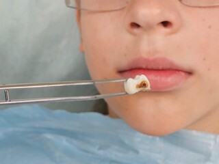 Dental procedure showing extracted tooth held with forceps in a clinical setting close to patient's...