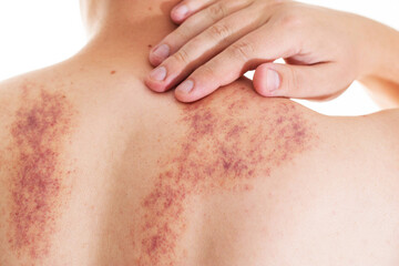 Fototapeta premium Redness and irritation on the skin of a man s back after a massage. Pimples and red spots with bruises on the skin, close-up