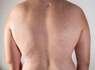 Red pimples on a man's back. Hormonal imbalance and increased testosterone, close-up