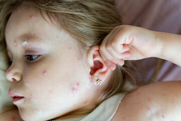Fototapeta premium Viral disease. Close-up portrait of a girl with a rash on her face from chickenpox, smeared with antiseptic