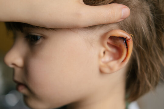 Stitches on the kid torn ear, dissection, suturing, bruise on the ear after impact and injury. 