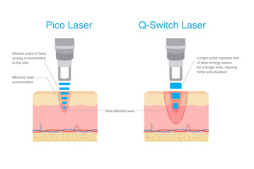 Area of Pico laser pulse effected with skin layer and Q switch laser. Difference of treatment with laser ray type. Dermatology Technology for Removal dark spot and scar.