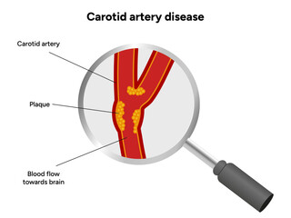Carotid artery disease Signs of Carotid Artery Disease medical illustration diagram