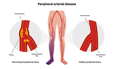 Peripheral Arterial Disease Daily Life and Mobility medical illustration 