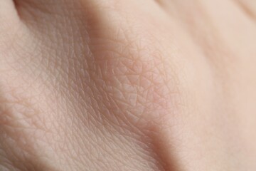 Texture of dry skin as background, closeup