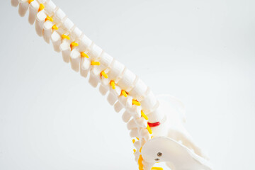 Naklejka premium Spinal nerve and bone, Lumbar spine displaced herniated disc fragment, Model for treatment medical in the orthopedic department.