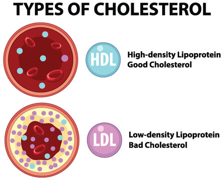Understanding Types of Cholesterol