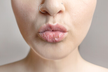 Woman shows dry lips, chapped, dry skin problem with mouth disease, Dry lips kiss