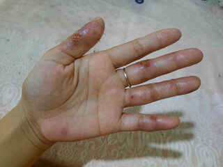 allergies on the fingers that are inflamed, atopic dermatitis or eczema