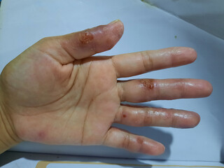 allergies on the fingers that are inflamed, atopic dermatitis or eczema