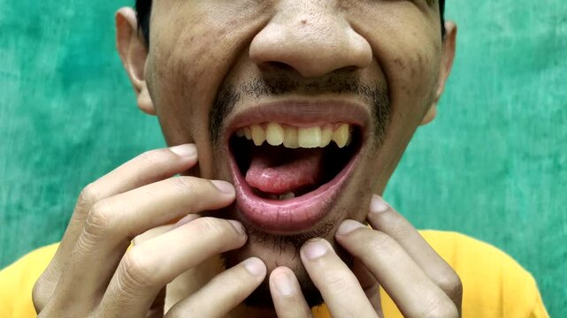 A person has thrush or aphthous stomatitis on the tongue. Thrush on the tongue starts from a wound caused by biting the tongue.