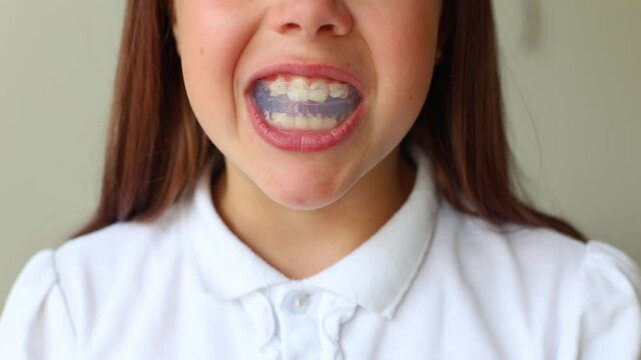 A young girl demonstrates how to put on and showcase her orthodontic retainer designed to correct her bite and improve her smile. This close-up footage provides insights into the importance of dental 