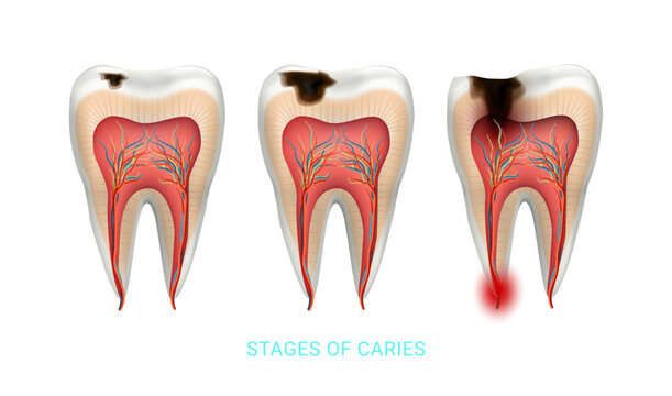 Stages of caries development in human molar. Vector isolated unhealthy tooth with dark, decayed area on occlusal surface with visible pits and holes. Dental diseases, cavities and periodontitis