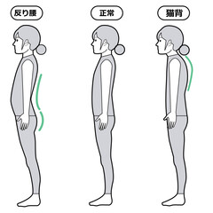 反り腰と猫背の状態