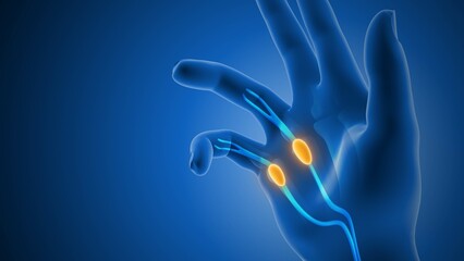  Dupuytren’s Contracture Leading to Painful Hand Stiffness
