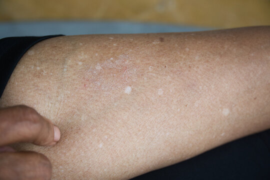 Idiopathic guttate hypomelanosis (IGH) is a common, harmless skin condition that causes small, flat, white spots on the skin. It's usually found on the arms, legs, and face of older people