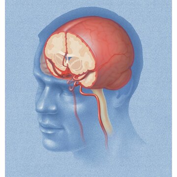 coronal view illustration of human brain showing the areas of subarachnoid hemorrhage