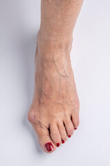 Close-up view of a woman's foot with obvious bunion problem