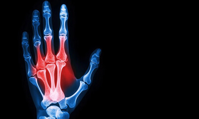 엑스레이, 손목, 손가락, 통증, 정형외과