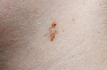 Close-up of a Mole on Human Skin