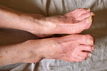 Fototapeta premium A person's feet with a swollen foot on a bed