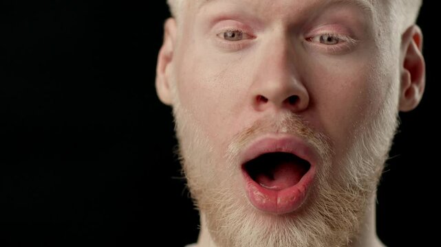 A young man with albinism shares his personal experiences and challenges related to his condition. He has white skin and hair, engaging in a candid discussion about identity. - Powered by Adobe