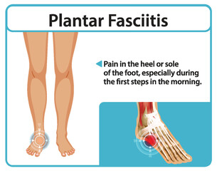 Understanding Plantar Fasciitis Pain Relief
