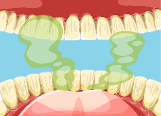Illustration of Bad Breath and Oral Health