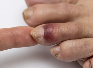 Obraz premium A person's foot has a bruise and a red mark