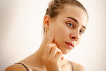 Beautiful young woman with pimples and acne on the face. Medicine and cosmetology concept. Natural...