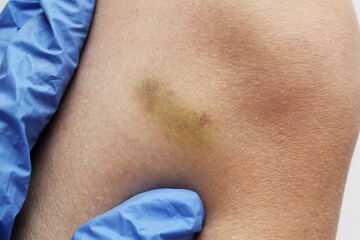 Checking bruise injury on woman knee. Bruise on the leg of an woman after domestic violence....