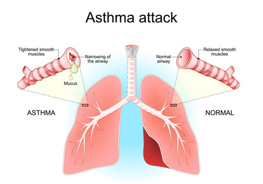 Asthma attack. Lungs, bronchi and airways. bronchospasms