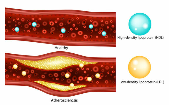Cholesterol. Low-density lipoprotein (LDL)High-density lipoprotein (HDL). Atherosclerosis, arterial plaque 