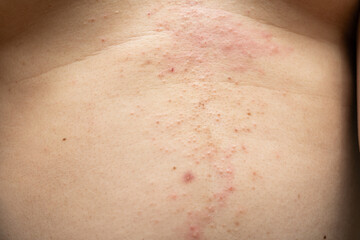 Fototapeta premium Atopic eczema on the stomach. Allergy, allergic reaction from atopic, hand in scratching itchy, itch red spot or rash of skin.