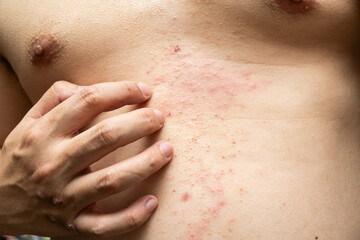 Fototapeta premium Atopic eczema on the stomach. Allergy, allergic reaction from atopic, hand in scratching itchy, itch red spot or rash of skin.