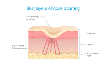 Skin layers of Acne scarring. Under scar in the dermis layer have fibrous bands pulling scar down. Anatomy of human facial skin with acne scar.
