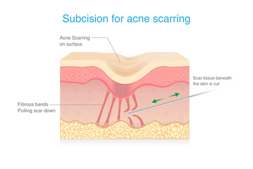 Subcision for Acne Scars treatment. Cut fibrous bands under skin layers tethered down within skin with small needle for treatment. Micro surgical technique.