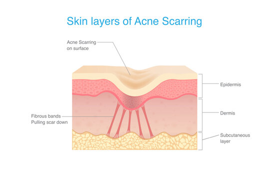 Skin layers of Acne scarring. Under scar in the dermis layer have fibrous bands pulling scar down. Anatomy of human facial skin with acne scar.