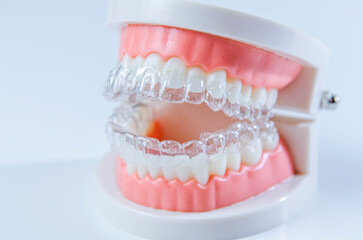 Close-up. Transparent aligners are placed over the teeth of an artificial jaw.