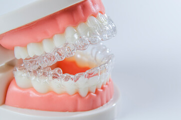 Invisible dental teeth brackets teeth aligners on blue background. Plastic braces dentistry retainers to straighten teeth on a white background